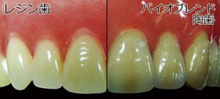 ツルーバイト人工歯使用例