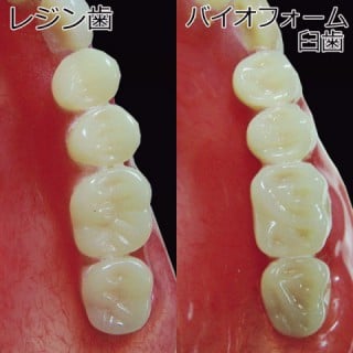 ツルーバイト人工歯使用例